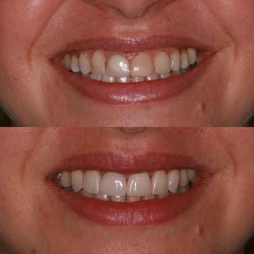 Un sorriso prima e dopo un trattamento di odontoiatria cosmetica